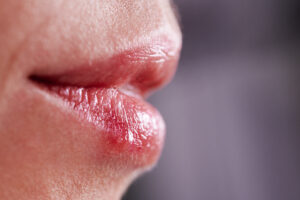 Close up of a women's lips suffering with cold sores (herpes virus)