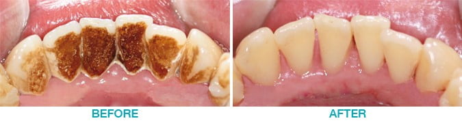 Teeth hygiene before and after comparison